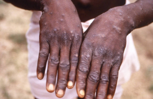 Viruela de mono: Qué es y cuáles son sus síntomas