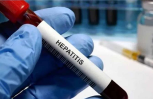 Secretaría de Salud de Hidalgo confirma muerte de menor de 3 años por hepatitis aguda infantil