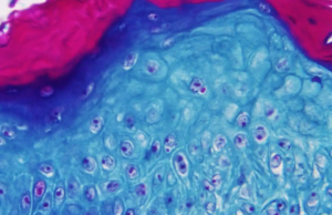 Argentina confirma caso de viruela del mono