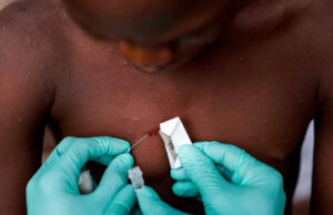 ONU pide no estigmatizar a personas contagiadas de viruela del mono