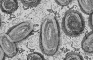 Quintana Roo suma tres caso de viruela del mono