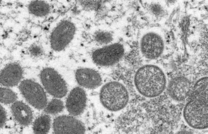 Viruela del mono: la OMS declara la alerta máxima por el aumento de casos