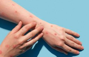 Contagios de viruela del mono aumentaron 20% en una semana: OMS