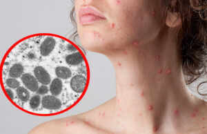 Yucatán registra seis nuevos casos de Viruela del Mono, van 24 personas contagiadas